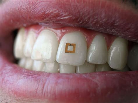 rfid chip in teeth|Your Mouth on a Chip .